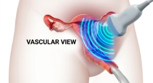골반 내부 장기와 초음파 탐촉자의 원리를 설명하는 학술적 3D 일러스트